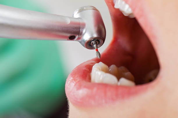 Best Emergency Dental Extractions in Austin, TX